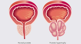Eliminates the symptoms of prostatitis
